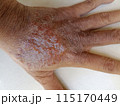 rash eczema dermatitis  on finger hand. inflammation of skin 115170449
