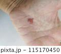 fly insect bite on hand. skin infection allergy 115170450