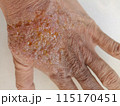 rash eczema dermatitis  on finger hand. inflammation of skin 115170451