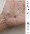 fly insect bite on hand. skin infection allergy 115170454