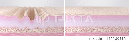 Wrinkled aged skin compared to young smooth skin. 3d rendered illustration. Cross-section of skin tissues before and after hyaluronic acid injections, collagen peptides, laser therapy, EMS, RF facelif Wrinkled aged skin compared to young smooth skin. 3d rendered illustration. Cross-section of skin tissues before and after hyaluronic acid injections, collagen peptides, laser therapy, EMS, RF facelif 115180513