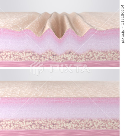 Wrinkled aged and young smooth skin comparison. 3d rendered illustration. Cross-section of skin tissues before and after hyaluronic acid injections, collagen peptides, laser therapy, EMS, RF facelift 115180514