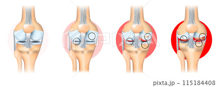 Stages of knee joint osteoarthritis Stages of knee joint osteoarthritis 115184408