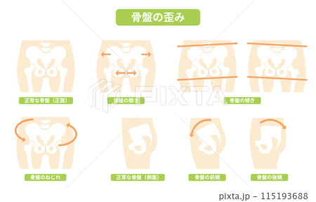 2024-人体-骨盤のゆがみイラスト 2024-人体-骨盤のゆがみイラスト 115193688