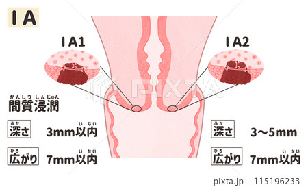 子宮頸がんステージⅠA（1A期）　わかりやすい日本語図解イラスト 115196233