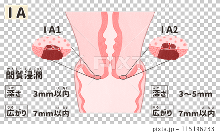 子宮頸がんステージⅠA（1A期）　わかりやすい日本語図解イラスト 115196233
