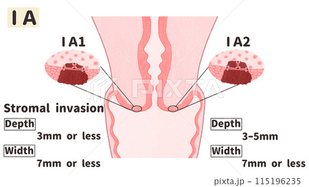 子宮頸がんステージⅠA（1A期）　わかりやすい英語図解イラスト 115196235
