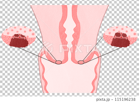 子宮頸がんステージⅠA（1A期）　わかりやすい図解イラスト 115196238