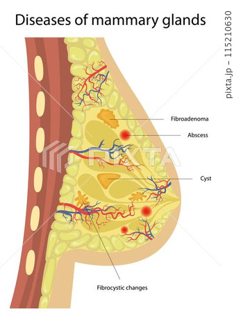 Of breast disease. Breast disease. Of breast disease. Breast disease. 115210630