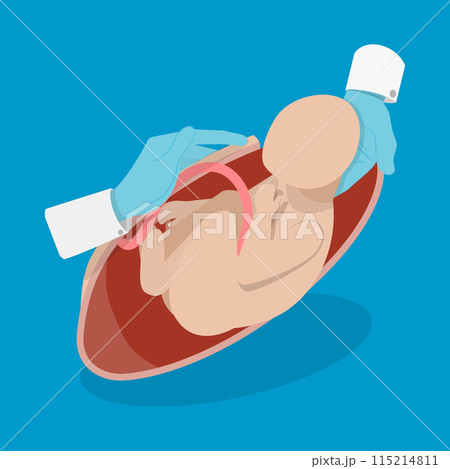3D Isometric Flat Vector Illustration of Cesarean Section, Medical Surgery and Abdominal Incision 3D Isometric Flat Vector Illustration of Cesarean Section, Medical Surgery and Abdominal Incision 115214811