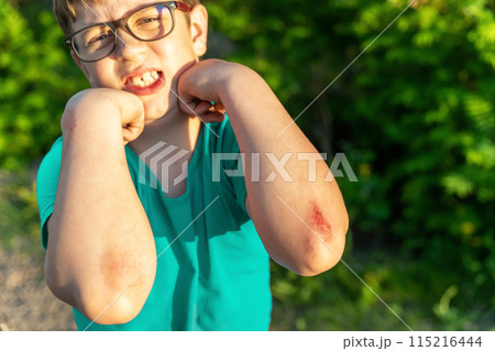 A young boy with a broken elbow, showing a bloody wound on his arm 115216444