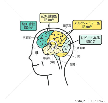 高齢者が認知症によって損傷を受ける脳の部分とその名称のイラスト 高齢者が認知症によって損傷を受ける脳の部分とその名称のイラスト 115217677
