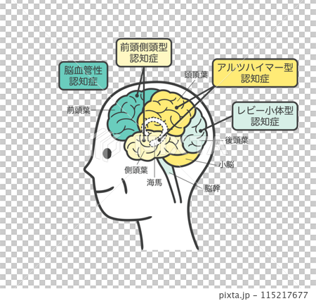 高齢者が認知症によって損傷を受ける脳の部分とその名称のイラスト 高齢者が認知症によって損傷を受ける脳の部分とその名称のイラスト 115217677