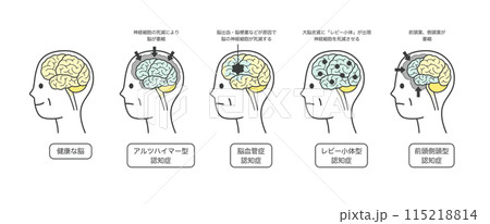 高齢者が認知症によって損傷を受ける脳の部分とその名称のイラストのセット 115218814