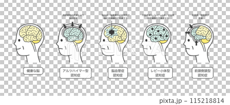 高齢者が認知症によって損傷を受ける脳の部分とその名称のイラストのセット 115218814