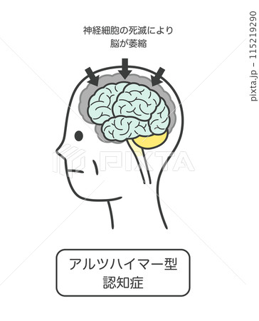 アルツハイマー型認知症によって損傷を受ける脳の部分とその名称のイラストのセット 115219290