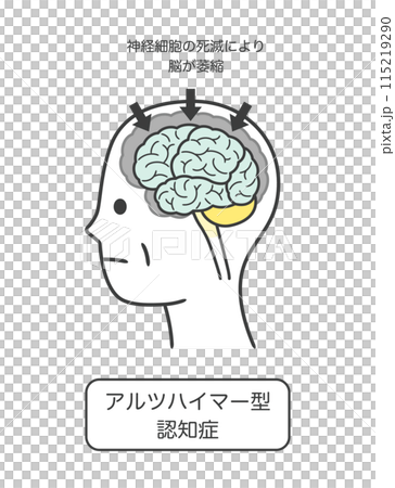 アルツハイマー型認知症によって損傷を受ける脳の部分とその名称のイラストのセット 115219290