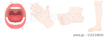 舌、歯、手、足、手足口病のイラスト、illustration 115219630