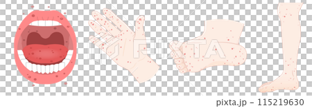 舌頭、牙齒、手、腳，手足口病圖解 115219630
