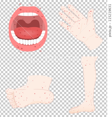 Tongue, teeth, hands, feet, hand, foot and mouth disease illustration, illustration Tongue, teeth, hands, feet, hand, foot and mouth disease illustration, illustration 115219631