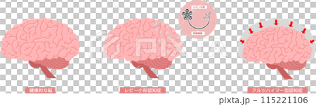 Brain dementia set 115221106