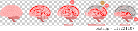 Brain stroke set 115221107