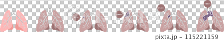 Lung cancer illustration set 115221159