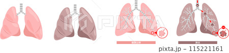 肺炎のセットイラスト 115221161