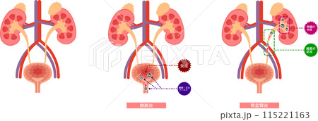 膀胱炎腎盂腎炎のセットイラスト 115221163