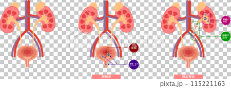 膀胱炎腎盂腎炎のセットイラスト 115221163