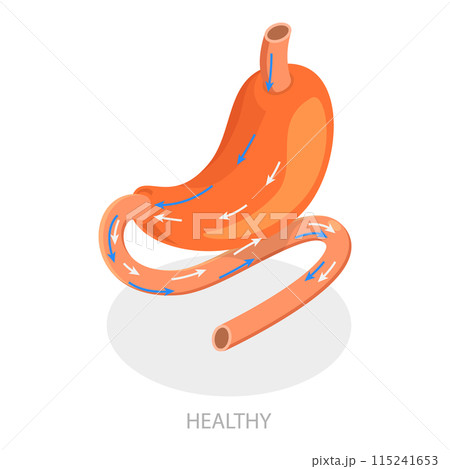 3D Isometric Flat  Illustration of Types Of Bariatric Surgery. Item 4 115241653