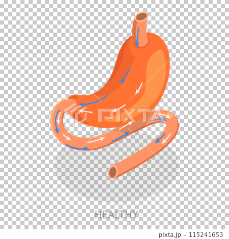 3D Isometric Flat  Illustration of Types Of Bariatric Surgery. Item 4 115241653