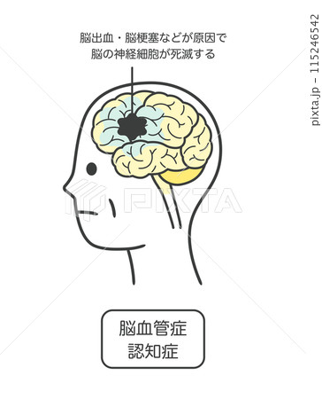 脳血管性認知症によって損傷を受ける脳の部分とその名称のイラスト 脳血管性認知症によって損傷を受ける脳の部分とその名称のイラスト 115246542