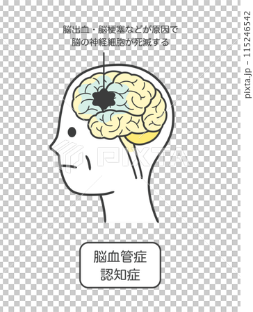 脳血管性認知症によって損傷を受ける脳の部分とその名称のイラスト 脳血管性認知症によって損傷を受ける脳の部分とその名称のイラスト 115246542