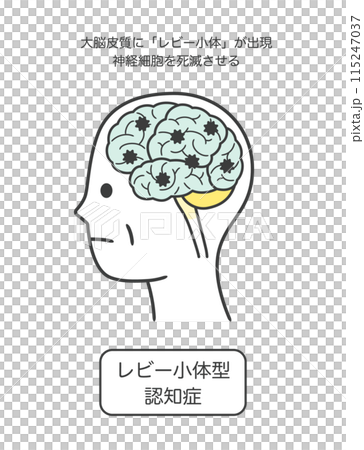 路易氏體失智症受損的腦部部位圖解及其名稱 115247037