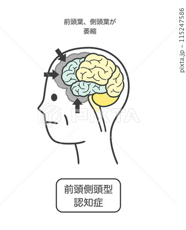 前頭側頭型認知症によって損傷を受ける脳の部分とその名称のイラスト 前頭側頭型認知症によって損傷を受ける脳の部分とその名称のイラスト 115247586