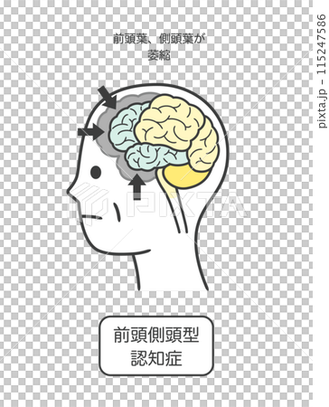 前頭側頭型認知症によって損傷を受ける脳の部分とその名称のイラスト 前頭側頭型認知症によって損傷を受ける脳の部分とその名称のイラスト 115247586