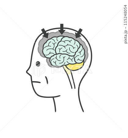アルツハイマー型認知症によって損傷を受ける脳の部分のイラストのセット 115248054