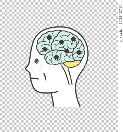 Illustration of parts of the brain damaged by Lewy body dementia 115248710