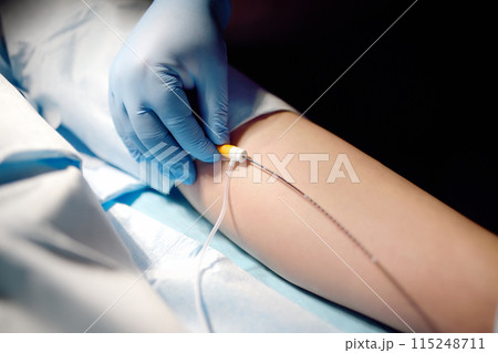 Professional vascular surgeon is in the operating room of the clinic during vein surgery. Phlebectomy. Modern technology of deep vein thrombosis treatment. Professional vascular surgeon is in the operating room of the clinic during vein surgery. Phlebectomy. Modern technology of deep vein thrombosis treatment. 115248711