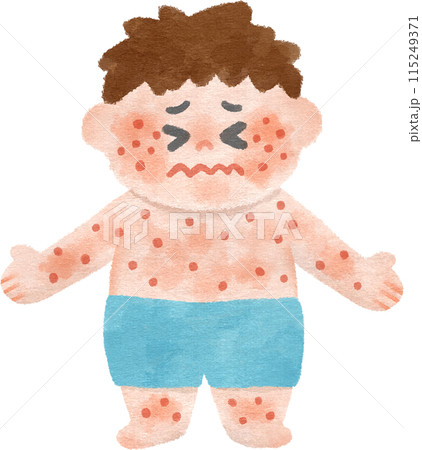 全身に発疹ができて苦しい男の子 手描きイラスト素材 全身に発疹ができて苦しい男の子 手描きイラスト素材 115249371