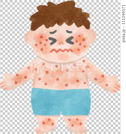 A boy suffering from a rash all over his body Hand-drawn illustration 115249371