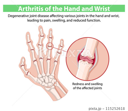 Arthritis of the Hand and Wrist 115252618