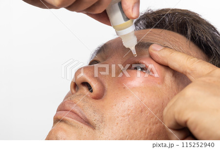 Senior man use antibiotic eye drops to treat swollen eye from insect bite. 115252940