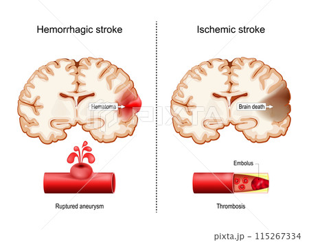Hemorrhagic and Ischemic strokes. 115267334