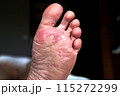 Close up of dry feet. Peeling and cracked foot. Fungal infection or athlete's foot, dry skin, dermatitis, eczema, psoriasis, sweaty feet or dehydration. Health care concept. 115272299