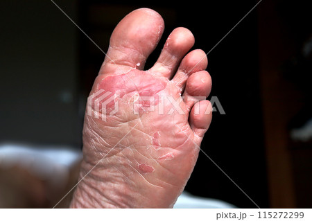 Close up of dry feet. Peeling and cracked foot. Fungal infection or athlete's foot, dry skin, dermatitis, eczema, psoriasis, sweaty feet or dehydration. Health care concept. Close up of dry feet. Peeling and cracked foot. Fungal infection or athlete's foot, dry skin, dermatitis, eczema, psoriasis, sweaty feet or dehydration. Health care concept. 115272299