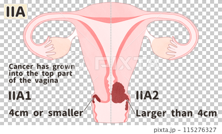 Cervical cancer stage ⅡA (stage 2A) Easy-to-understand English illustrations 115276327