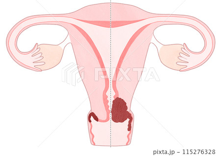子宮頸がんステージⅡA（2A期）　わかりやすい図解イラスト 115276328