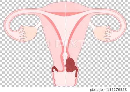 Cervical cancer stage ⅡA (stage 2A) Easy-to-understand illustration Cervical cancer stage ⅡA (stage 2A) Easy-to-understand illustration 115276328